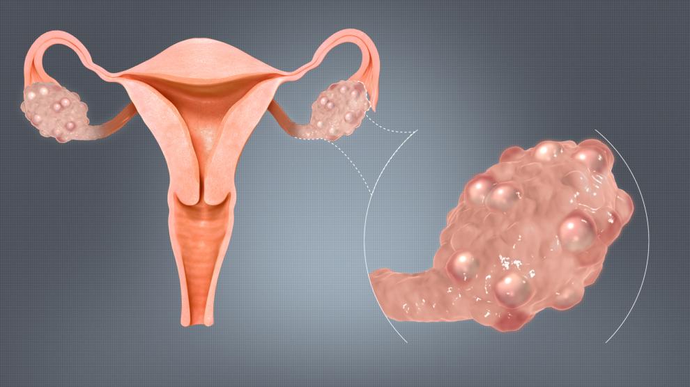 ovario poliquistico - Ambar Lab